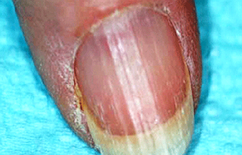 brittle nails