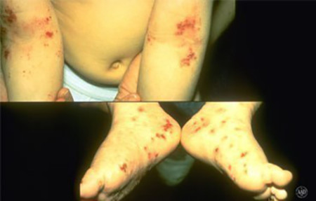 Atopic dermatitis in the creases of a boy's elbows and feet