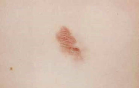 This raised, reddish-brown patch is a rare skin cancer called dermatofibrosarcoma protuberans