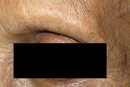 Complete loss of eyebrow